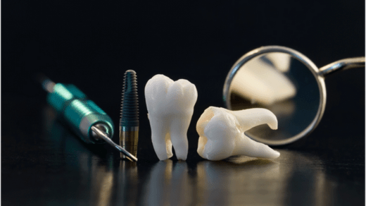 Dental Implant Tooth Replacement